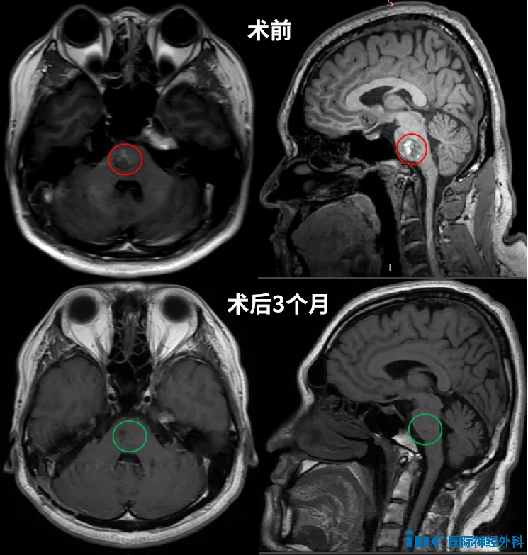术后情况: 无并发症 + 长期无复发