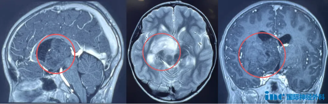右侧丘脑-基底节区出现占位性病变,肿瘤呈弥漫性生长趋势,脑室扩大,脑脊液循环已受影响