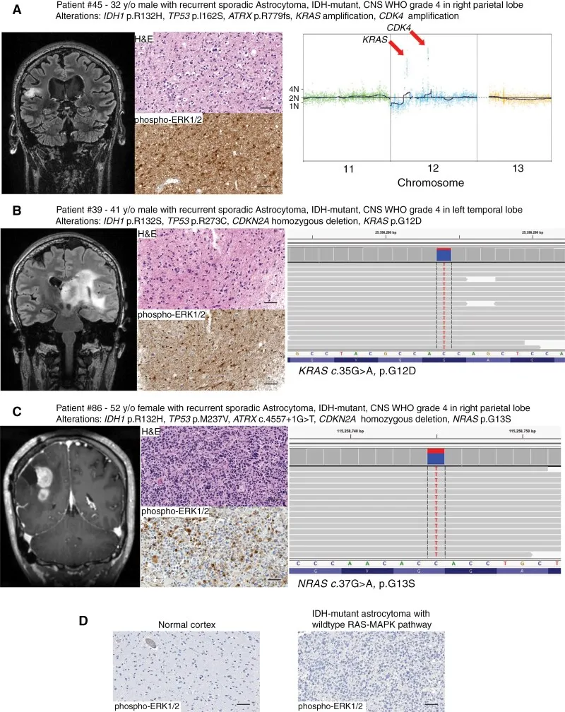 图示:复发性高级别散发性IDH突变型星形细胞瘤中存在多样化的RAS-MAPK通路致癌性改变。图示为3例代表性患者资料,包括冠状位对比增强T1加权磁共振图像、苏木精-伊红染色组织学图像、磷酸化ERK1/2(Thr202/Tyr204)免疫组化染色结果以及致癌性RAS-MAPK改变的示意图。(A)12号染色体短臂12.1区(12p12.1)KRAS致癌基因的局灶性高水平扩增。(B)KRAS p.G12D已知的激活热点错义突变。(C)NRAS p.G13S已知的激活热点错义突变。(D)正常大脑皮层与RAS-MAPK通路野生型IDH突变型星形细胞瘤的磷酸化ERK1/2(Thr202/Tyr204)免疫组化染色。