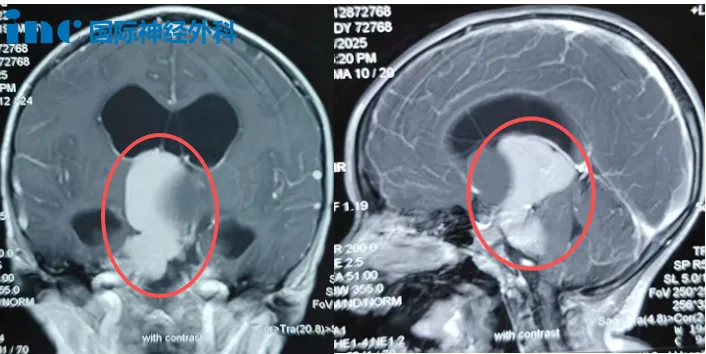 术前MRI，小安脑中的“大虫子”