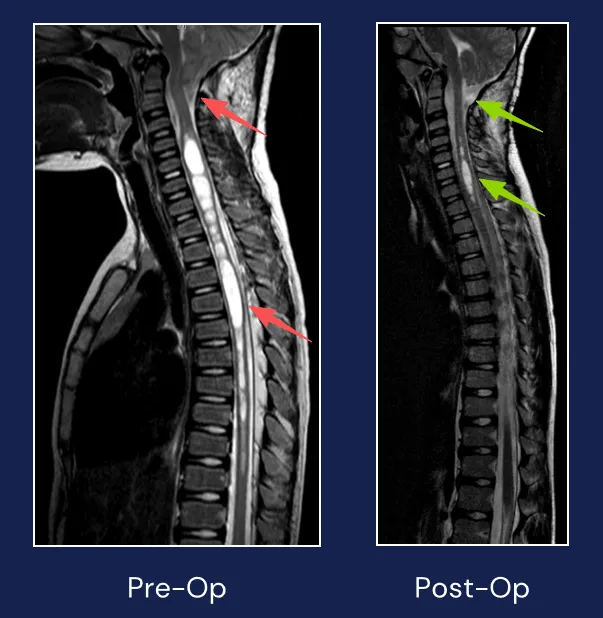 在Rutka(鲁特卡)教授的主刀下,手术十分顺利,小脑扁桃体下疝畸形成功去除后,玮玮的脊髓空洞也明显缩小。