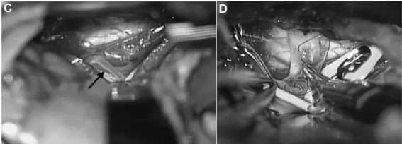 突发蛛网膜下腔出血却找不到病因?47岁患者的 “隐匿杀手”竟是夹层动脉瘤!