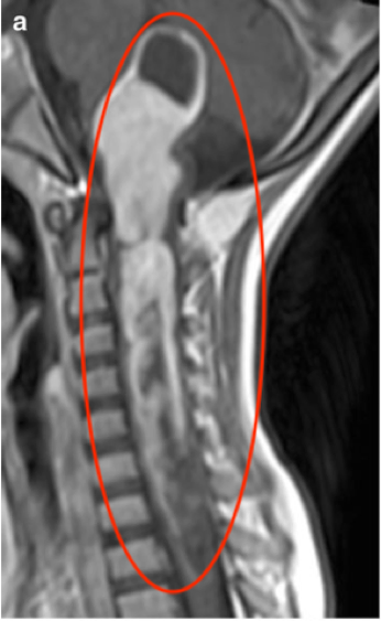 脑干胶质瘤一路长至胸髓，术前无法走路的他，最终摆脱瘫痪厄运！
