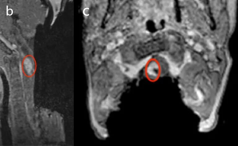 术中监测和运动诱发电位始终保持稳定,于是,巴教授在确认显微镜下达到令人满意的切除后,决定进行术中磁共振iMRI扫描检查,以明确肿瘤是否得到全切。