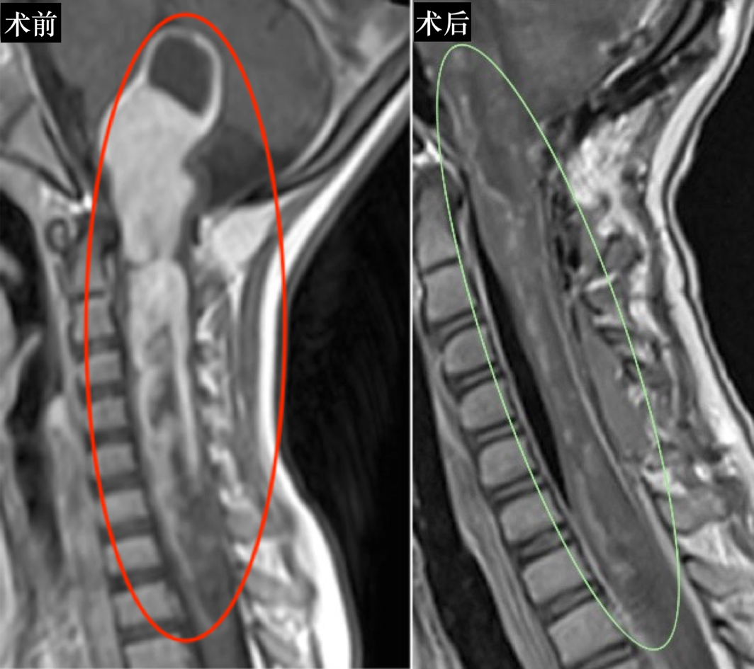为了确保孩子术后的正常行动,巴教授还进行了颅骨成形术及椎板原位复位术。