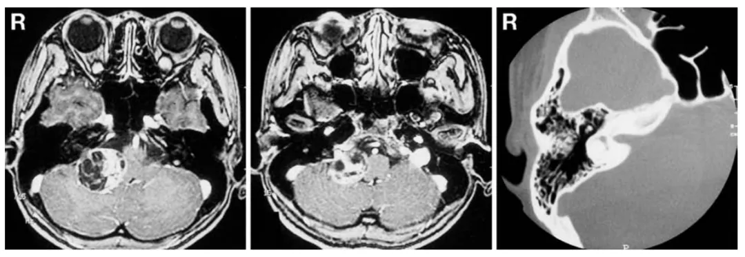 图1 术前轴位增强T1加权磁共振成像(左、中)显示,右侧桥小脑角区占位性病变,未明显侵犯颈静脉孔。术前骨窗计算机断层扫描(右)显示,内耳道无明显扩张。