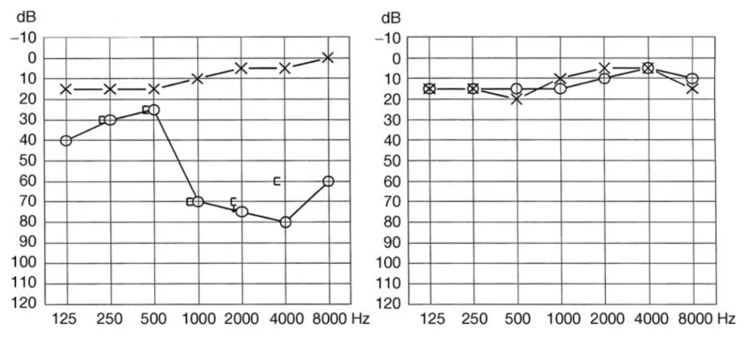 图2 术前纯音听力图（左）显示感音神经性耳聋。术后1周纯音听力图（右）证实有效听力恢复。 和 × 分别表示右耳和左耳气导听力，］ 表示右耳骨导听力。