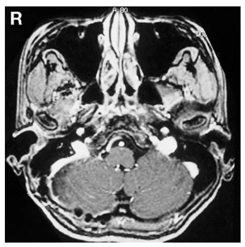 图3 术后8个月轴位增强T1加权磁共振成像显示,肿瘤无复发。