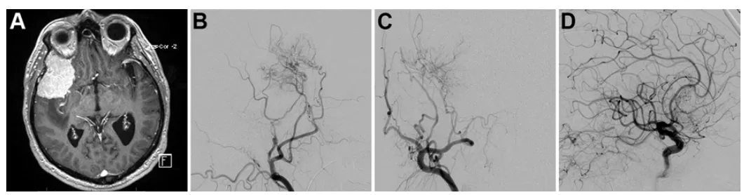 图示：一名67岁男性患者，确诊为大型右侧蝶骨嵴脑膜瘤，影像学显示肿瘤血供同时来源于颈内动脉（ICA）和颈外动脉（ECA）分支系统。