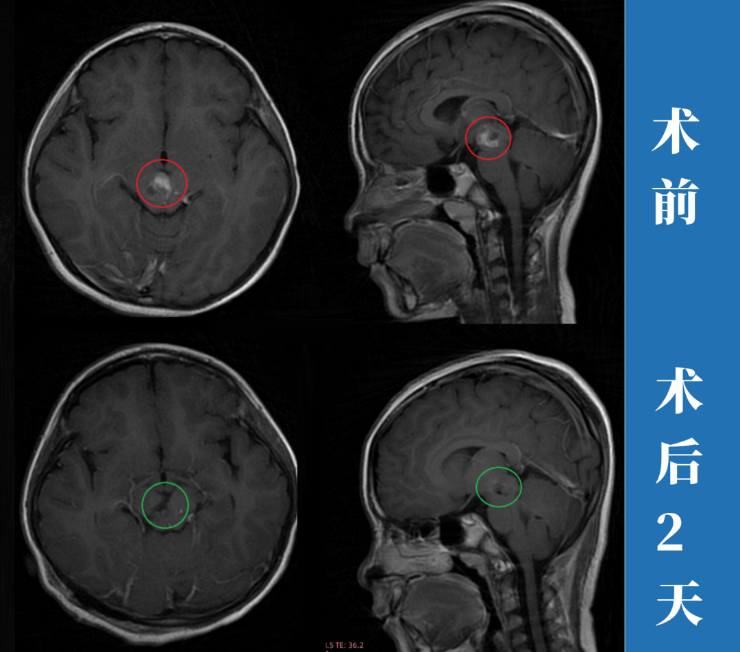 術前術後MRI對比