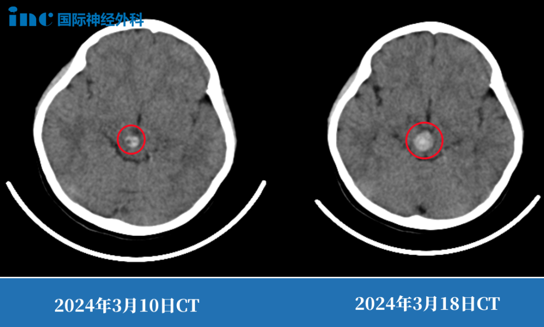 第二次出血,意味着病情的恶化,这一点在前后仅间隔8天的CT上就足以说明。
