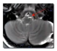 在2019年的术后20年复查中