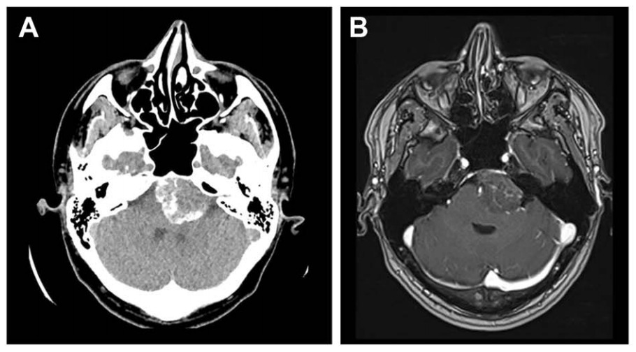 颅底脑膜瘤血供丰富、手术风险高怎么办?术前栓塞与多技术融合保障手术安全