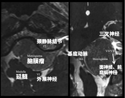 可见脑膜瘤与神经血管结构的复杂关系。