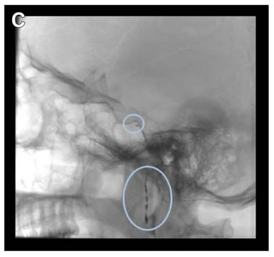 诺亚术前栓塞咽升动脉及脑膜垂体干