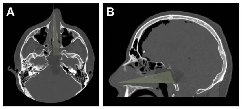 A、B：术后 CT 轴位及矢状位，绿色显示单鼻孔入路，鼻腔完整性得以保持；鼻中隔、上颌窦、后组筛窦及左侧蝶窦间隔均完整。
