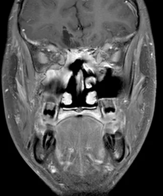 图7:冠状位T1加权钆增强MRI扫描,显示鼻腔和颅内肿瘤成分的大体全切。注意额叶占位效应的解决和肿瘤床无对比增强。