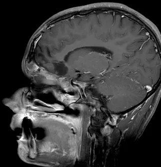 图8:矢状位T1加权钆增强MRI扫描,显示鼻旁窦和前颅窝肿瘤的大体全切。注意额叶无占位效应,肿瘤腔内无对比增强。