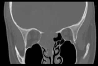 儿童鼻腔鼻窦未分化癌：病例报告与文献综述