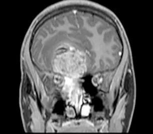 图2:冠状位T1加权钆增强MRI扫描,证实了起源于鼻腔并延伸至前颅窝的大肿瘤团块的发现。对额叶下部的占位效应和轻微的中线移位是明显的。