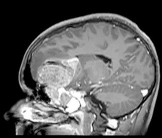 图3:矢状位T1加权钆增强MRI扫描,显示肿瘤团块从鼻旁窦侵蚀进入前颅窝。