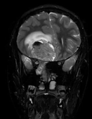 图4:冠状位T2加权MRI扫描,证实了颅内肿瘤成分的不均匀实性和囊性性质。病灶周围水肿以及肿瘤相关的中线移位也清晰可见。