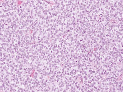 图5:H&E染色切片显微照片(40倍放大),显示实性片状的泡状核,高核质比,中度有丝分裂活性,以及明显的凋亡和坏死区域。