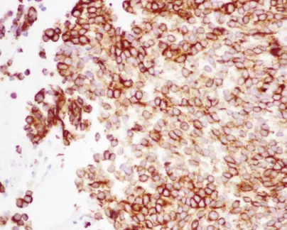 图6:显微照片(40倍放大),显示广谱细胞角蛋白弥漫阳性免疫组织化学染色。