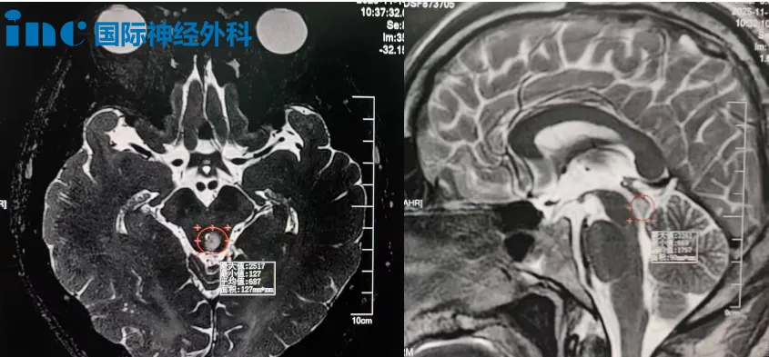 左侧小脑半球有一个约1.2×0.9×1.0cm的异常信号,第四脑室轻度受压;中脑背侧左侧份另见一个约0.6×0.6×0.5cm的异常信号,中脑导水管也轻度受压。