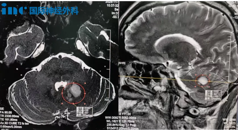 持续的头昏、记忆力下降、反应迟钝,已严重影响他的生活质量。