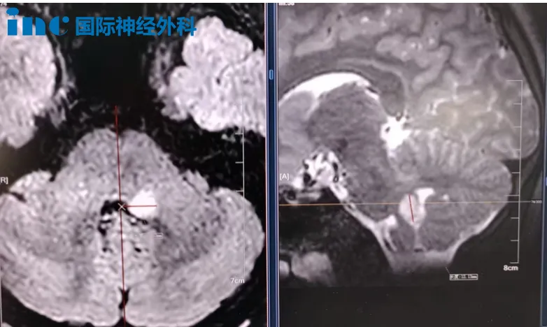 嘉乐的病灶在短短6个月从8毫米长至13×13×10毫米,且仍在持续增大。频繁的头痛、头晕,偶尔的恶心