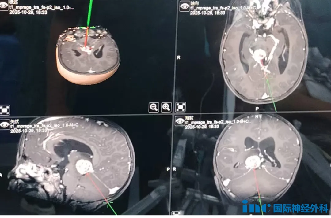 在巴特朗菲教授的主刀下，这台高难度的丘脑肿瘤切除手术顺利完成。