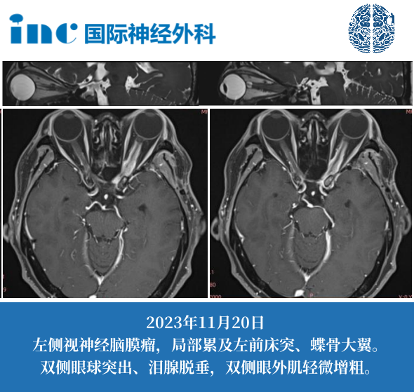 会不会彻底失明？以后还能自理吗？尽管恐惧，她从未放弃寻找希望，子女也全力支持她继续求医。