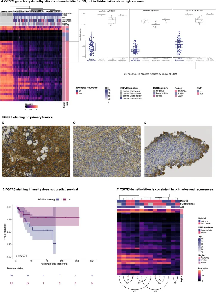 97%的病例观察到FGFR3基因体低甲基化伴FGFR3蛋白表达升高。
