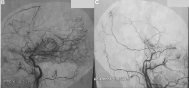 头痛四年元凶竟是烟雾病？这些早期信号要警惕