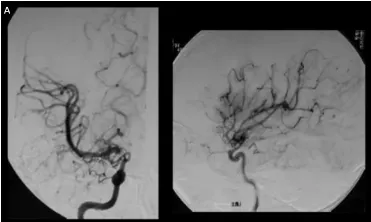 A,春奈术前右颈血管造影显示,在颈内动脉末端顶部,血管烟雾弥漫性发育,大脑中动脉扩张。