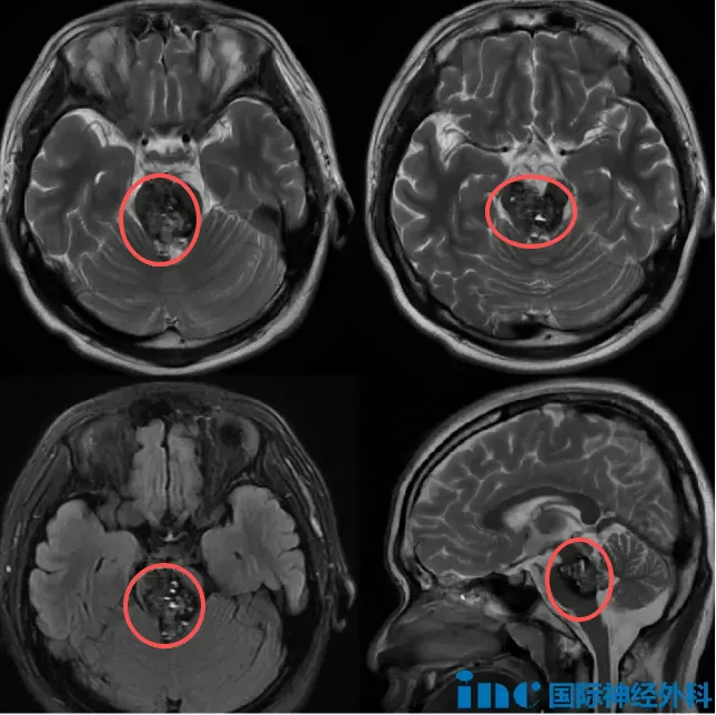 这个海绵状血管团还占据中脑,甚至从后往前将桥脑“截断”,十分难缠