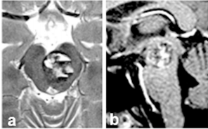 图a和b:术前轴向(a)和矢状(b)MRI