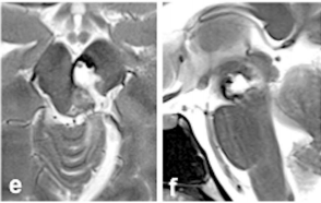 尽管出现了暂时性动眼神经麻痹,但在几周内就逐渐恢复,未留下任何神经功能缺损。