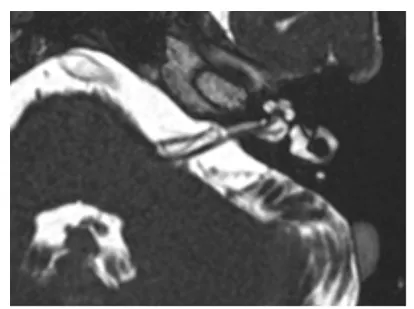 图1 术前三维T2加权磁共振成像显示： 第七、第八对脑神经复合体与小脑前下动脉襻存在疑似致病性神经血管冲突。