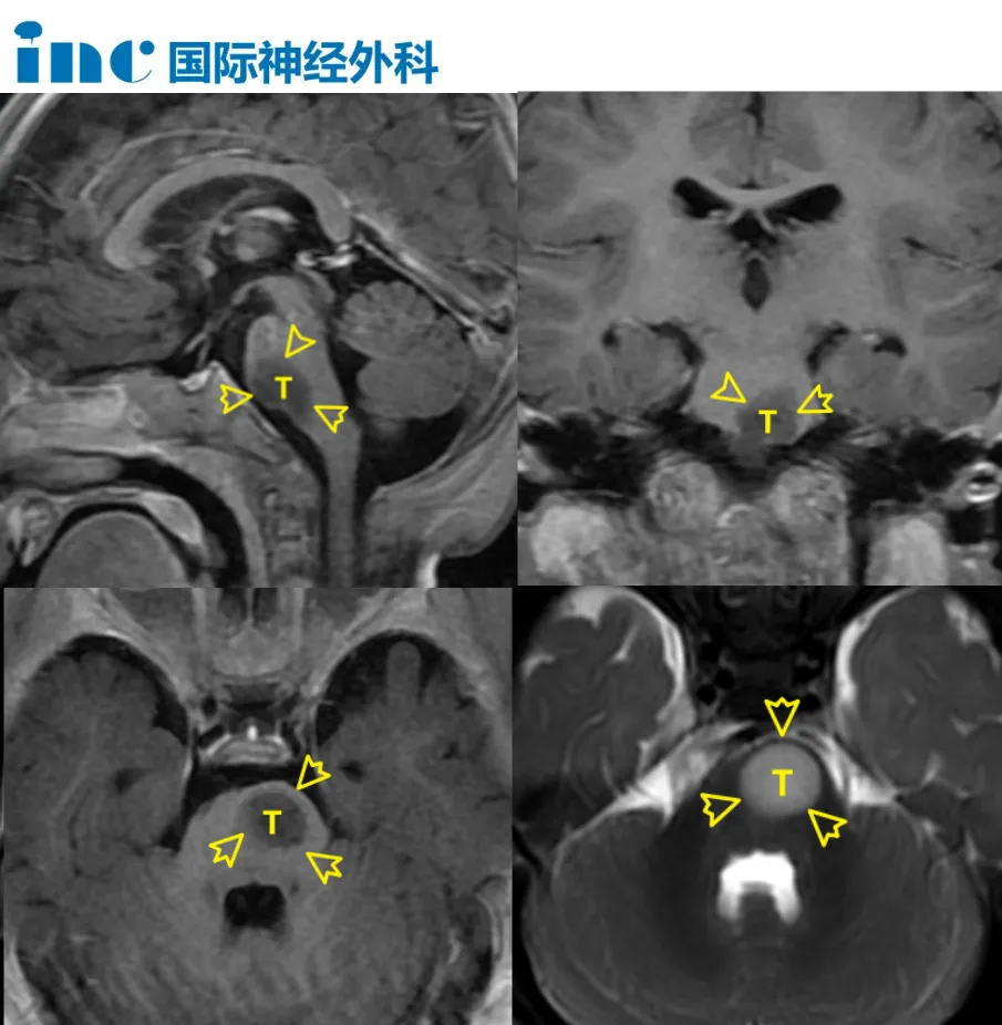 脑干存在占位性病变，考虑为胶质瘤