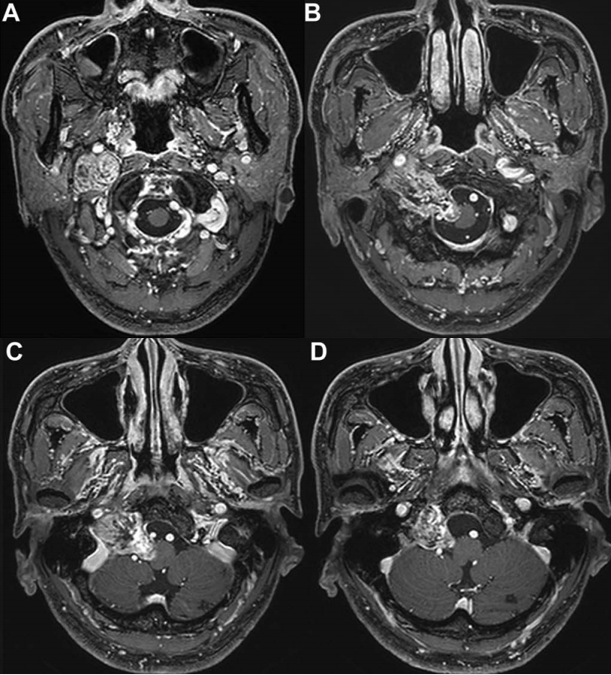 脑子里长了一个3.7厘米的巨大肿瘤