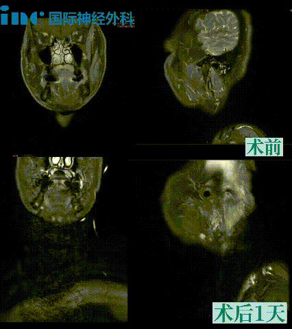 这是一名来自东南亚的颈静脉孔区神经鞘瘤患者。
