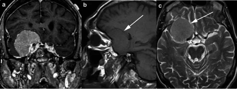一名有1个月精神疾病史的 80 岁女性的T1加权序列显示，右中颅窝底内有一个界限清楚、均匀增强的肿块，具有宽阔的硬脑膜尾，其下内侧接触右侧海绵窦。右颞叶上方被肿块压迫，但未侵犯。a、b为T2，显示该肿块（箭头所示）呈等灰质信号；c为T1，显示该肿块（箭头所示）呈均匀的轻度高信号（相对于灰质）。