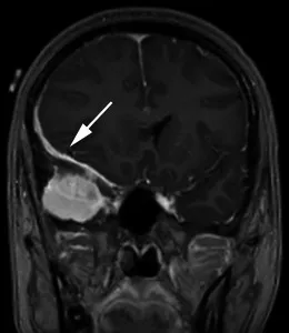 一名 35 岁头痛女性的造影后冠状 T1 加权序列显示，右中颅窝内有均匀增强的轴外质量，并有宽阔的硬脑膜尾（箭头）沿着蝶骨翼延伸，并围绕右额叶的侧面。肿块导致大脑镰下向左突出 7 毫米，右侧脑室消失。手术时的组织学结果为脑膜瘤（1 级）