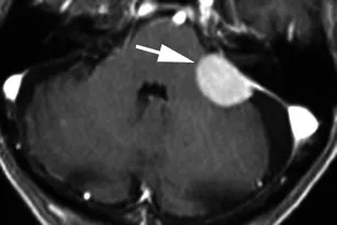 一名有头晕和易跌倒症状的 83 岁男性的造影后轴向 T1 加权序列显示，左侧桥小脑角（箭头）内有均匀增强的轴外肿块，具有宽阔的硬脑膜附着物和硬脑膜尾，向前延伸至左侧内耳道，向后延伸至乙状窦。肿块覆盖左侧内耳道，无泪小管内延伸。外观和组织学符合脑膜瘤（I 级）