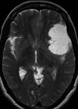 一名有 8 年晕厥发作史的 55 岁女性的轴向 T2 加权序列显示，左额叶下外侧和前颞叶有一个巨大的轴外肿块，明显高信号，略高于脑脊液。肿块后方有轻度血管源性水肿。组织学符合微囊性脑膜瘤。