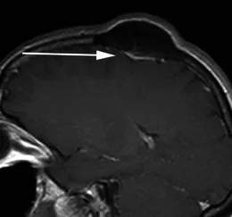 一名49岁女性患者，因头皮肿块就诊。其矢状位增强后T1加权序列显示，左侧顶骨可见一明显骨质增生灶，病灶主体向颅外突出。紧邻骨性病变下方，可见一薄片状、均匀强化的轴外软组织影（箭头所示），符合扁平型脑膜瘤的影像学特征，后经手术病理证实。