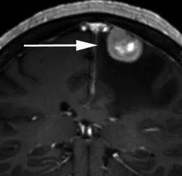 70岁头痛女性患者。增强冠状位T1加权序列显示右中央前回受压（箭头），病灶轻度不均匀强化，呈宽基底硬脑膜附着，周围显著血管源性水肿。T2加权序列呈高信号（相对于灰质）。术后病理证实为原发性乳腺癌腺癌转移。