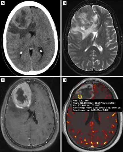 一名49岁患者，经病理证实为3级（间变性）脑膜瘤。A（平扫头颅CT）：显示右侧额叶巨大占位性病变，密度不均，周围伴血管源性水肿，并导致明显占位效应。B（横轴位T2加权MRI）：肿块呈不均匀信号强度，周边可见相对于高信号核心的厚壁低信号环。C（增强后MRI）：强化肿块内部可见中央强化减低区，提示存在中央坏死。D（灌注加权MRI）：相对脑血容量（rCBV）未见升高。